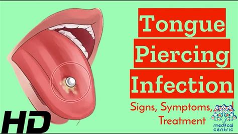 discharge from tongue piercing|Infected vs irritated piercing